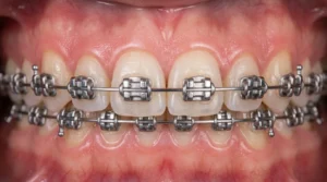 invisalign alternative